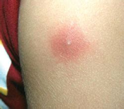 Maybe you would like to learn more about one of these? A 1-year-old female with blister on her left hand