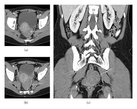 Doctors use ct scans (or cat scans) to look for broken bones, cancers, blood clots, and more. CT scan of the abdomen and pelvis (1/12/208). Axial (a ...