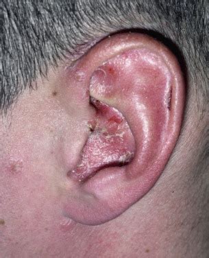 Las vegas — treating difficult eczema cases requires starting with the basics and advancing to approaches such as combination therapies and compounded prescriptions when needed, according. Seborrheic Dermatitis, Psoriasis, Recalcitrant ...