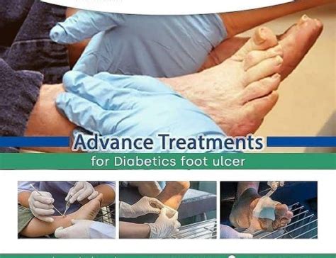 A diabetic foot ulcer can be redness over a bony area or an open sore. Diabetic Foot Ulcer Diagnosis and Treatment in Thailand ...