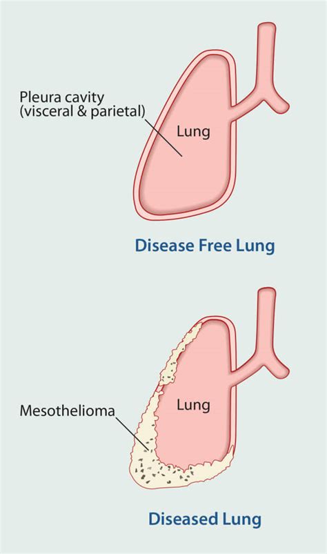 Check spelling or type a new query. Mesothelioma Symptoms | Comprehensive Cancer Information ...