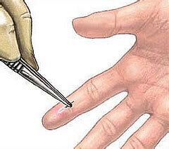 Trim the nail where the splinter is located to allow better access. How to Remove a Splinter | genuinefirstaid.blogspot.com ...