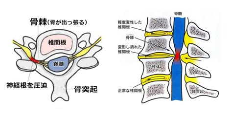 頚椎症性神経根症