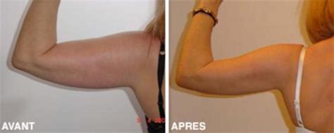 Nous proposons des prix chirurgie esthétique tunisie tout compris incluant à la fois votre opération esthétique ainsi que votre séjour médical en pour maintenir notre bonne réputation à l'échelle internationale, nous avons réuni les leaders de la chirurgie esthétique en tunisie pour piloter des. Lifting bras Tunisie : prix chirurgie bras pas cher