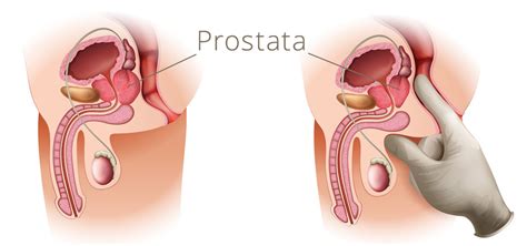 Wann wird eine prostata mrt durchgeführt? 17 HQ Pictures Prostatauntersuchung Ab Wann ...