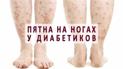 Как похудеть если тебе за 50 сахарный диабет