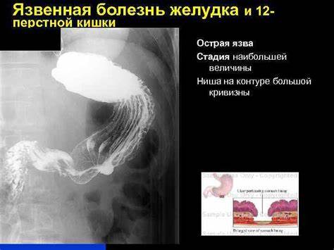 Острая язва диета Рентгенодиагности ка язвенной болезни желудка Кафедра лучевой диагностики Рентгенодиагности ка язвенной болезни желудка Кафедра лучевой диагностики Острая язва диета