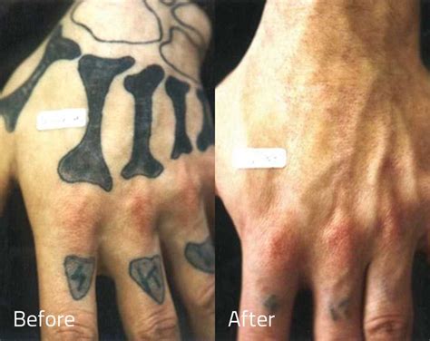 This code specifies the standard for the conduct of body art procedures, sets standards for the process by which the department and its delegate agencies 10 Best images about Tattoo Removal Before and After on ...