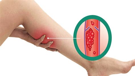 Deep vein thrombosis (dvt) is the formation of a blood clot in a deep vein, most commonly in the legs or pelvis. Alimentação inadequada pode aumentar os riscos de trombose ...