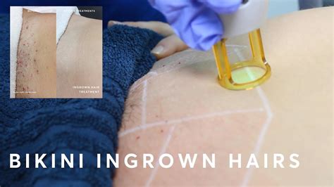 Hair was right under the skin. How to get rid of ingrown hairs with laser hair removal ...