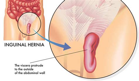 The lump might appear skin colored or have a purple hue. Anatomy Of Inguinal Hernia Repair - Anatomy Drawing Diagram