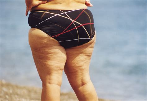 One medical definition of cellulite is 'oedematous fibrosclerotic. ~Dreamer~: I Anti Cellulite with Celmonze!