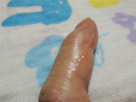 指の先に小さい水泡がいっぱい!痛くも痒くも無い この正体は ...
