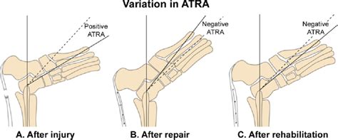 Learn the basics of achilles tendon. The relative Achilles tendon resting angle (ATRA ...