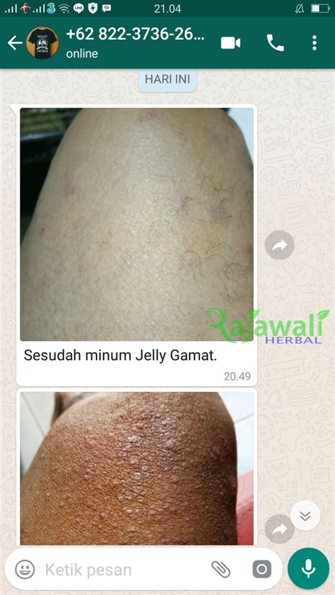 Tangan yang kebas biasanya pada satu sisi dan itu akan menjalar ke seluruh tangan tersebut di mana lengan pun akan terkena efeknya juga. 4 Obat Untuk Jari Tangan Gatal Bernanah Berair dan Bengkak ...