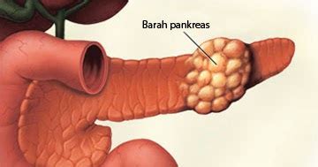 Pankreas yaklaşık 15 cm büyüklüğünde, sindirim sisteminin bir parçası olarak kabul edilen. Info Kesihatan: Kenali kanser pankreas