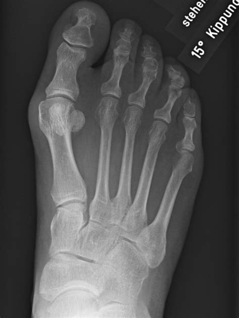 Wann eine operation sinnvoll ist welche methoden es gibt tipps für die nachsorge. Hallux valgus - beidseitige Operation - Wuppertaler Fuß ...