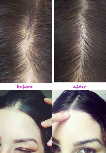 Get a silky, shiny hair. castor oil hairline before and after regrowth photos ...