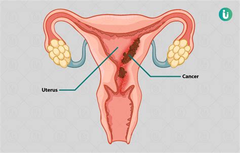 What are the symptoms of a recurrence? Endometrial Cancer (Uterine Cancer) symptoms, causes ...