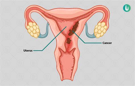 The modern procedure tends to be minimally invasive, done through small incision sites to lessen pain afterward. Endometrial Cancer (Uterine Cancer) symptoms, causes ...