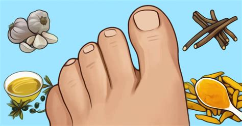 Apprenez à vous débarrasser des cors aux pieds avec ces remèdes maison