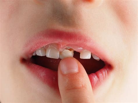 When the new tooth under it grows in enough it will painlessly push out the top one. What to Do for Wiggly Teeth | Fort Collins Family ...