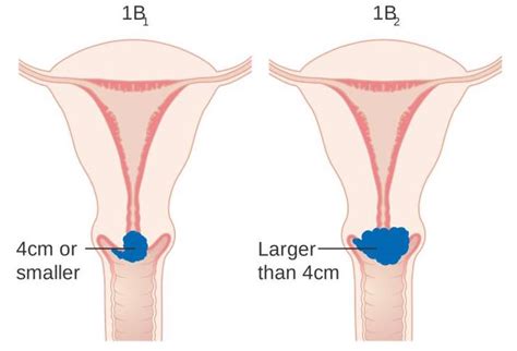 The cervix is the narrow part of the lower uterus. Colposcopy | CancerQuest