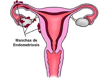 An early diagnosis, a multidisciplinary the main complication of endometriosis is impaired fertility. Endometriosis - Información médica en Ferato, enciclopedia ...