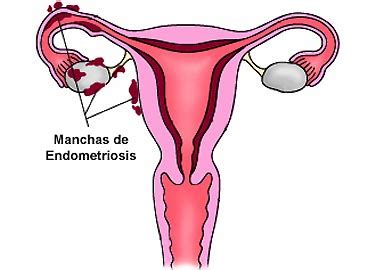 Endometriosis occurs when the lining of the uterus (endometrium) which is normally shed every. Endometriosis - Información médica en Ferato, enciclopedia ...