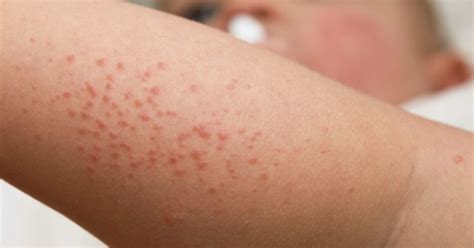 Home health tips heat rash: Baby heat rash: Types, diagnosis, and treatment