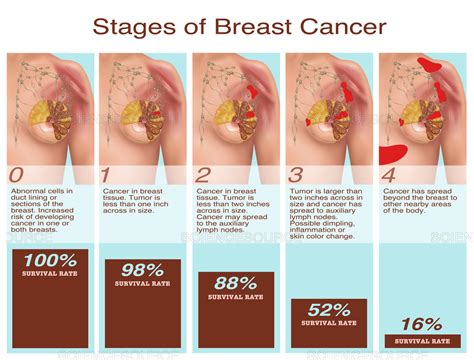 Although breast cancer can occur at any age, it is most commonly diagnosed in men in their 60s, according to the mayo clinic. Science Source - Breast Cancer Stages, Illustration