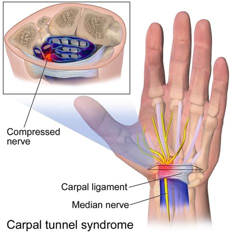 This nerve runs from the. Exercises to Prevent Carpal Tunnel Syndrome