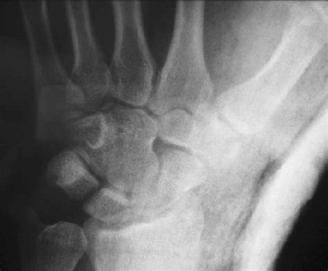 Figure 5 from Carpometacarpal dislocation of the thumb ...