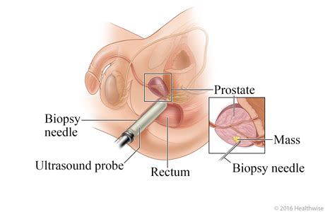 How long does it take to learn javascript if you know java. Prostate Biopsy: About This Test