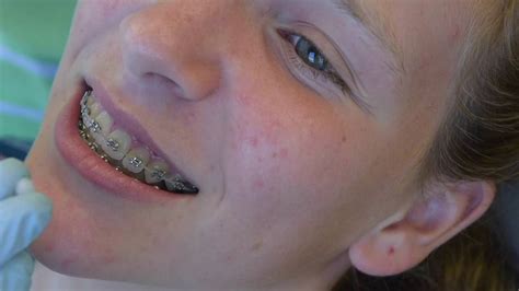 It's pretty easy and useful. How to use orthodontic wax at Mullen Orthodontics - YouTube