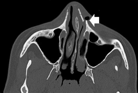 Computed tomography scan imaging with bone window reconstruction ...