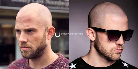 Check spelling or type a new query. Micro Hair Pigmentation | Beauty Care Nederland