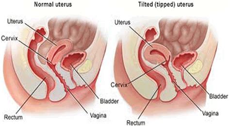 • common symptoms include pelvic. 【生理痛の原因に!】子宮後屈の症状と対策
