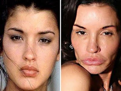 You will never want to have such lips, right? Haus of Bazaar: Janice Dickinson: Before and After