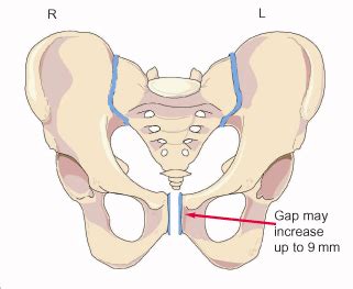The pain is caused by stiffness or uneven movements of the pelvic joints in pregnancy, which affects up to 1 in 5 women. SPD - Symphysis Pubis Dysfunction - Rock and Roll Pussycat