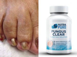As with apple cider vinegar, we have learned that this isn't always the case, and sometimes problems take time to show up in the body. NutraPure Fungus Clear Review - Clear Discount | Go Away ...