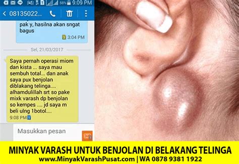 Untuk mengobati benjolan di belakang telinga, cara paling ampuh dan alami adalah dengan qnc jelly gamat obat benjolan di telinga herbal. KEMPES, Minyak Varash Untuk Benjolan Di Belakang Telinga