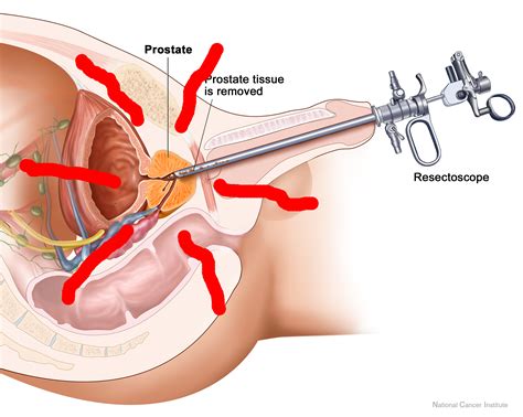 10 nov 2016 05:17 in response to r_v_b1984. Do I have Prostate Cancer?