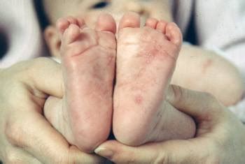Pruido intenso e difuso (interfe ou impede o sono) com manifestações cutâneas: Escabiose - Distúrbios dermatológicos - Manuais MSD edição ...