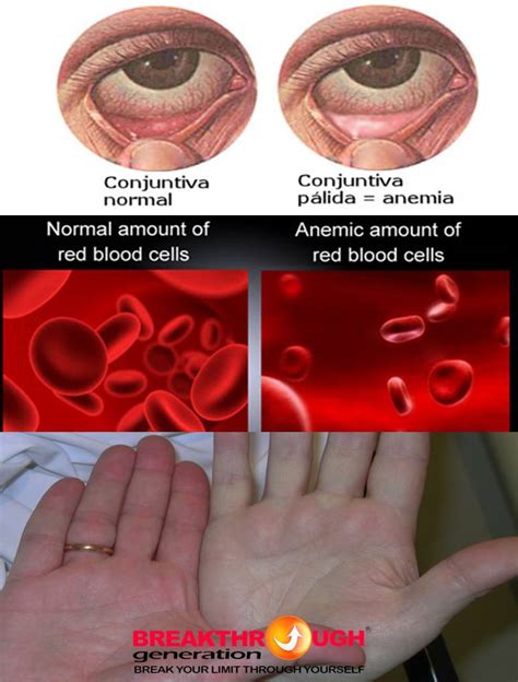 Penelitian bertujuan untuk mengetahui hubungan antara sikap untuk mengkonsumsi ttd. Gambar Orang Anemia