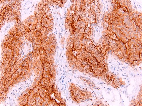 Maybe you would like to learn more about one of these? Pathology Outlines - Mesothelioma versus adenocarcinoma