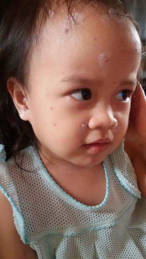 Chicken pox (or varicella) is a viral infection that causes a unique rash. Anak Kena Chicken Pox, Apa Perlu Saya Buat?