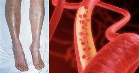 La leucemia è un tumore del sangue, di cui ancora non è chiara la causa scatenante, anche se generalmente si imputa ad una mutazione del dna. 5 facili esercizi per glutei, addominali e cosce tonici