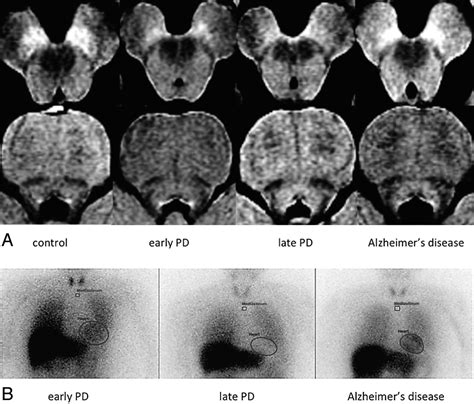 Maggie often plays mothers because … such roles provide lots of opportunities to an actress. Evaluation of Parkinson Disease and Alzheimer Disease with ...