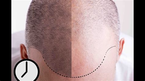 For men who are experiencing thinning hair, their follicles on the top of the head are genetically vulnerable to baldness. SMP Hair Pigmentation - An Overview of this New Hair Loss ...